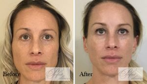 Dermal Filler contouring