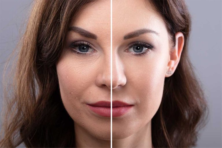 Fillers before and after treatment in Palm Beach area | Dermatologist in Palm Beach