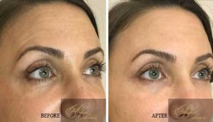 Neurotoxin before and after results of real patients at Palm Beach (cause 1) | Fillers in Palm Beach for Natural Facial Contouring