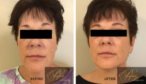 Dermal Fillers Treatment before and after results of real patients at Palm Beach (cause 2)