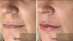 Dermal Fillers Treatment before and after results of real patients at Palm Beach (cause 10)