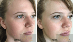 Dermal Fillers Treatment before and after results of real patients at Palm Beach (cause 14) | Hyperdilute Radiesse | Fillers in Jupiter