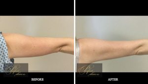 Tumescent Liposuction before and after results of real patients at Palm Beach (cause 17) Fat Reducing Treatment in Juno Beach, FL