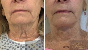 Surgical Lift before and after results of real patients at Palm Beach (cause 4)