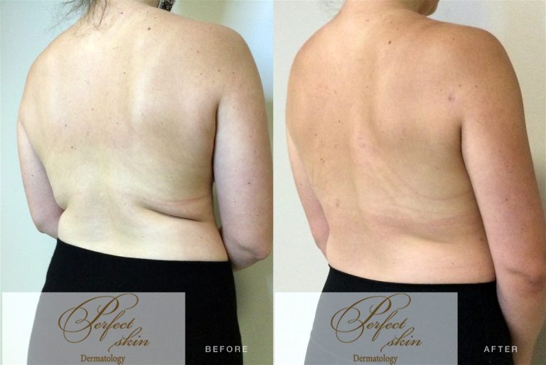 Before and After Results of Tumescent Liposuction Treatment