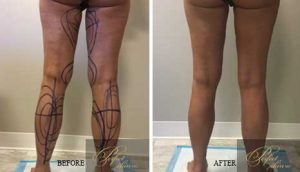 Tumescent Liposuction before and after results of real patients at Palm Beach (cause 8)