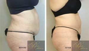 Tumescent Liposuction before and after results of real patients at Palm Beach (cause 3)