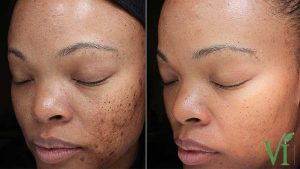 Chemical peel before and after results
