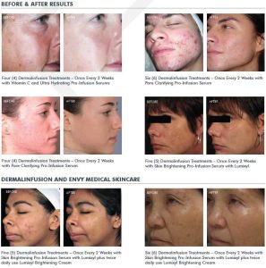 Diamondglow Facial Juno Beach before and after