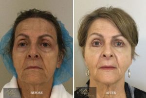 Fat transfer before and after treatments of real patient