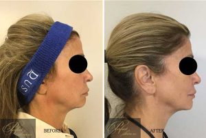 Profound real patient before and after