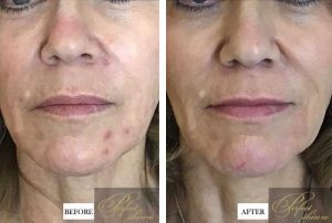 Profound real patients before and after at Perfect Skin MD | Profound Facial Treatment: Non-Surgical Skin Tightening & Collagen Boosting