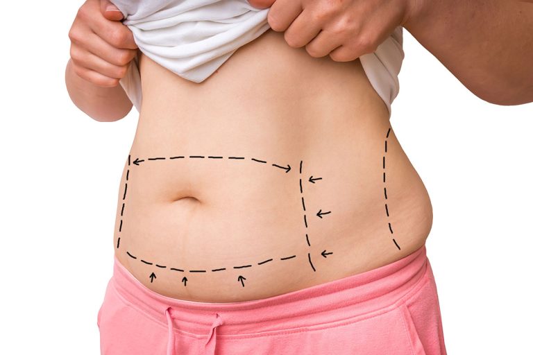 Safest Form Of Liposuction in Juno Beach, FL Area