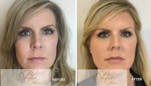 Profound Before & After Results , Case - 11