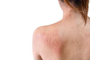 Skin Rashes Treatment in Juno Beach FL Area