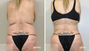 Tumescent Liposuction of Back Before & After Results , Case - 26