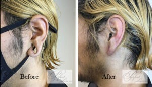 earlobe repair surgery