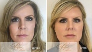 Profound RF for Aging Skin in Juno Beach | Skin Tightening