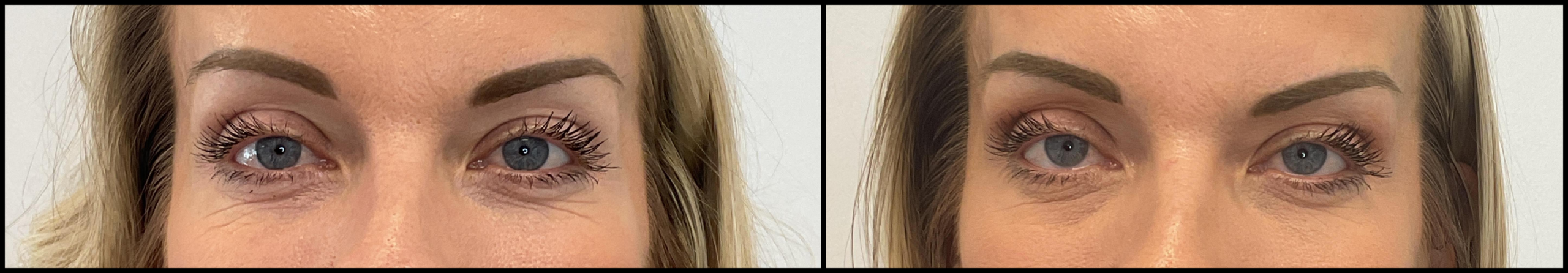 Achieve Radiant Skin: CO2 Laser Skin Resurfacing Results