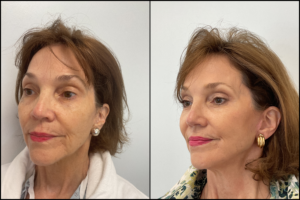 Facelift Juno Beach | Natural Face and Neck Lift