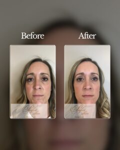 Recontouring with fillers in Palm Beach