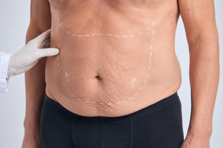 Minimally Invasive Post Ozempic Skin Tightening in Juno Beach