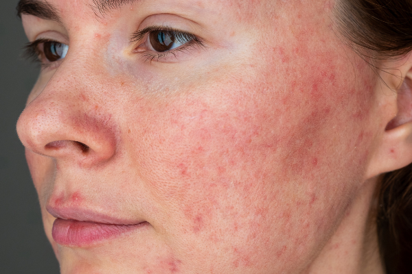 Dermatologist-Led Rosacea Treatment Options in Juno Beach, Florida