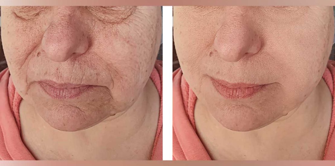 Fractionated CO2 Laser Resurfacing treatment Before and After results