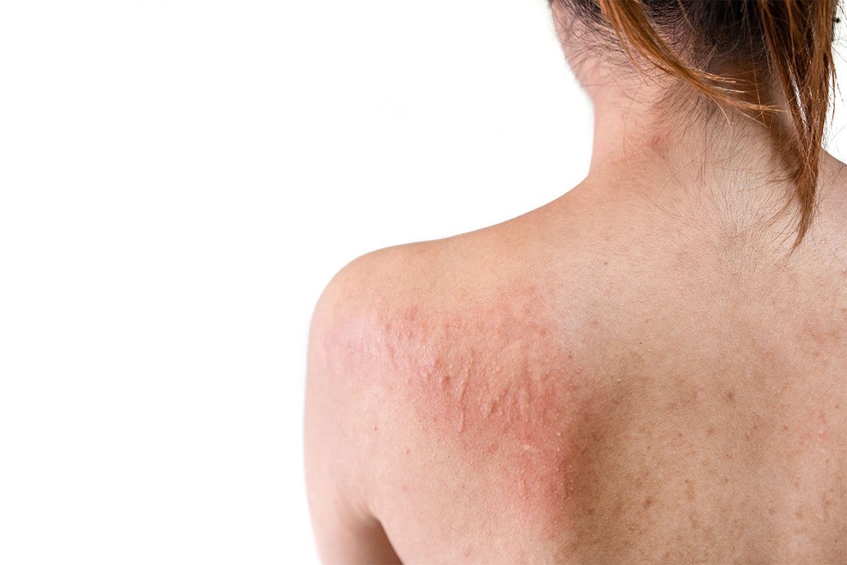 Skin Rash Treatment in Juno Beach FL Area