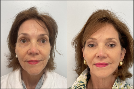 Facelift Juno Beach | Natural Face and Neck Lift