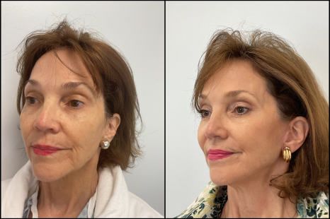 Facelift Juno Beach | Natural Face and Neck Lift
